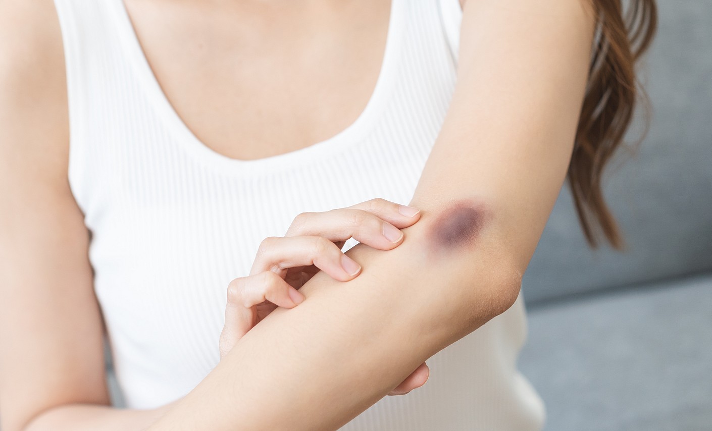 arm-frau-hämatom-immunthrombozytopenie